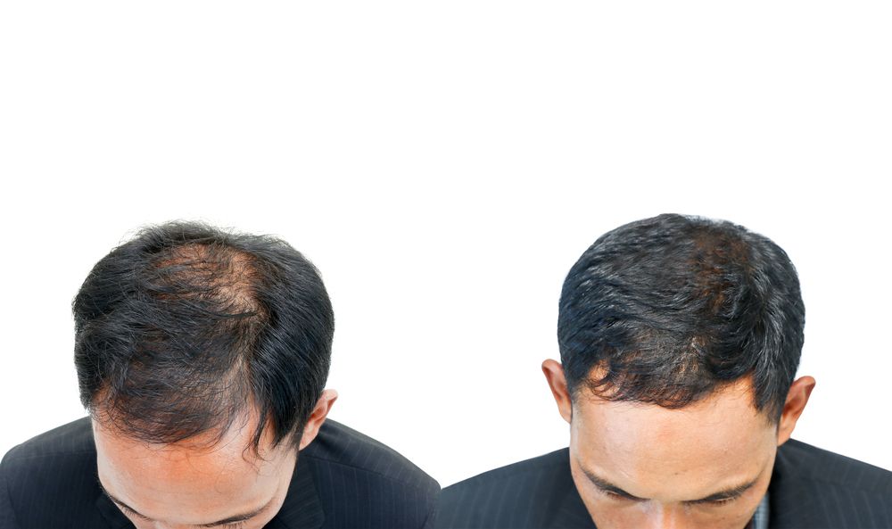 Ohne Operation gegen Glatze und Haarverlust