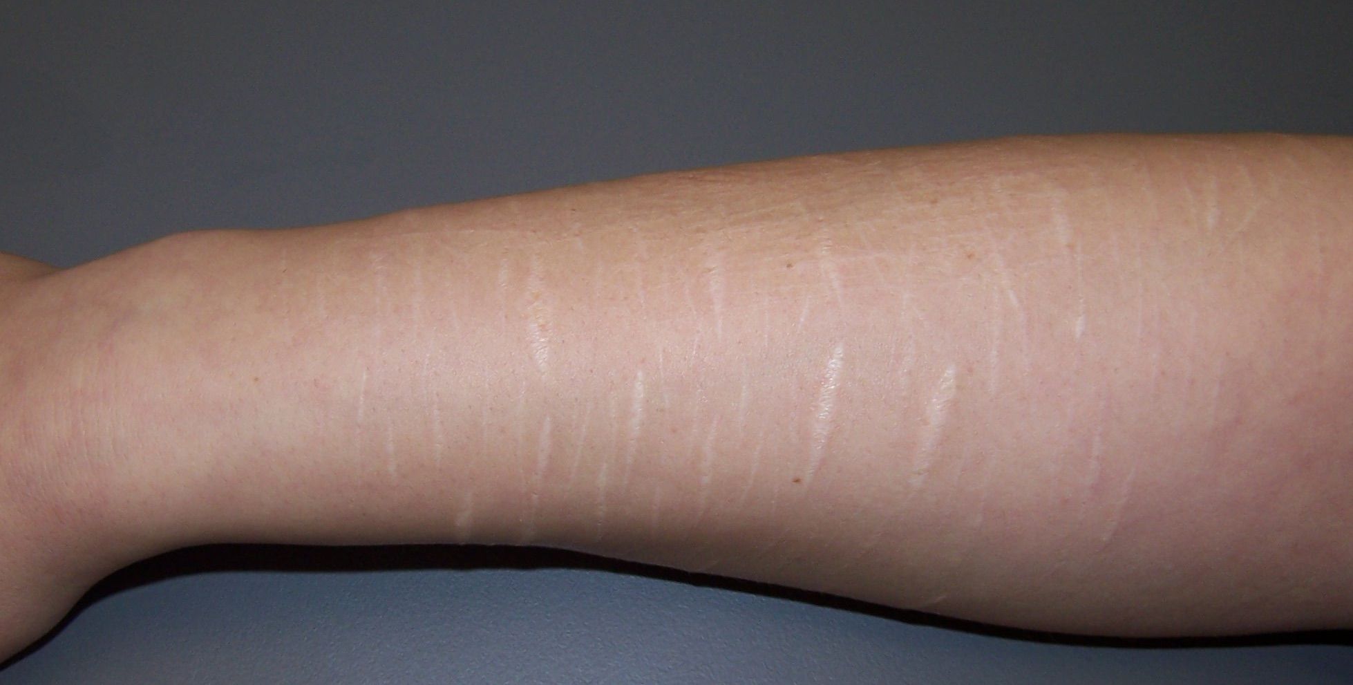 Korrektur von auffälligen, zu hellen Narben - jetzt unaufwändig möglich